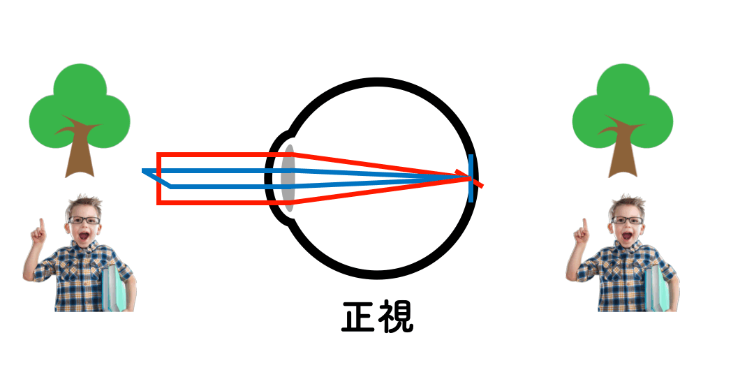 乱視×ビジョントレーニング-視力Aでも眼が良いとは限らない?!- | VT Base Fukuoka